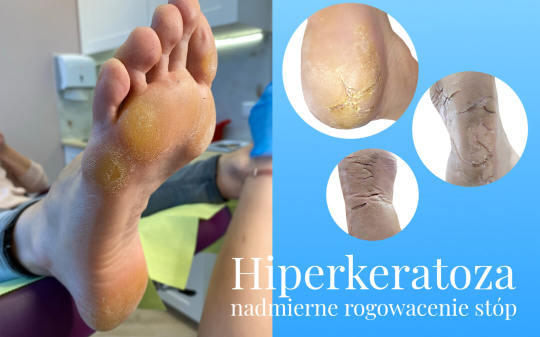 Hiperkeratoza – nadmierne rogowacenie stóp.